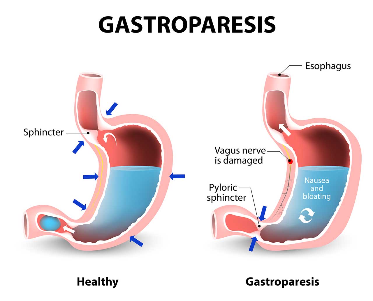 Gastroparesis Diet Modification